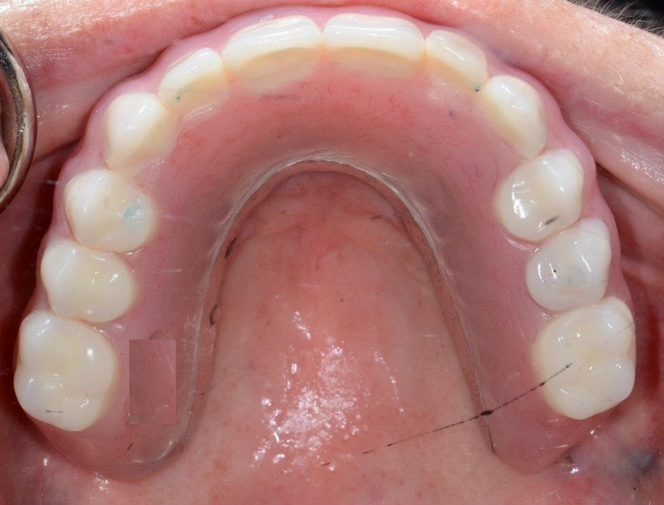 Types Of Partial Dentures Banning CA 92220